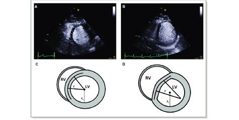 flattening of the interventricular septum.